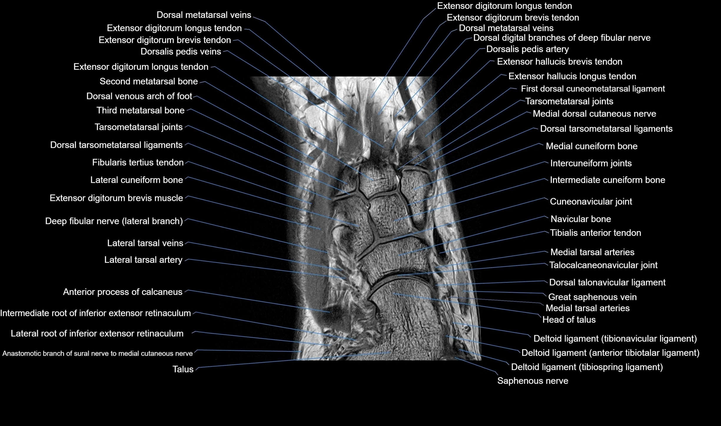 MRI mid foot coronal ligaments cross sectional anatomy 3T  radiology  image-img-00001-00015.webp